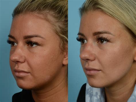 buccal fat removal 10 years later|What Happens to Your Face 10 Years After Reducing。